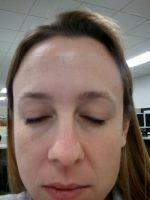 Doctor Brian K. Brzowski, Salt Lake City Plastic Surgeon Botox Shots