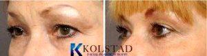 Doctor Christopher Kolstad, MD, San Diego Facial Plastic Surgeon - Botox