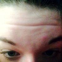 Doctor Marc J. Salzman, Louisville Plastic Surgeon Botox Botulinum Toxin Type A