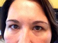 Doctor Nana N. Mizuguchi, Louisville Plastic Surgeon Botox Botulinum Toxin Type A Results