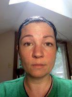 Doctor Tom Haas, Louisville Plastic Surgeon Botulinum Toxin