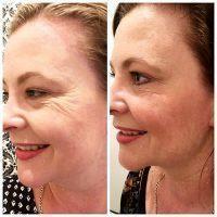 Dr Caren Campbell, San Francisco Plastic Surgeon Botox OnabotulinumtoxinA