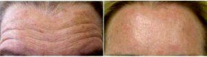 Dr Deborah E. Mendelson, MD, Phoenix Dermatologist - 53 Year Old Woman Treated With Botox