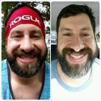 Dr Martin Fox, Louisville Plastic Surgeon Botulinum Injection