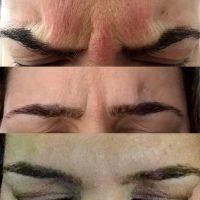 Dr Michael I. Echavez, San Francisco Plastic Surgeon Cosmetic Botox Injections