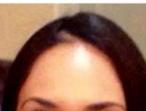 Dr Remus Repta, Phoenix Plastic Surgeon Botox Injection Procedure Patient Pictures Results