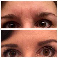 Dr Tim Sayed, San Diego Plastic Surgeon Botox Toxin Results