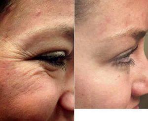 Dr Todd Christopher Hobgood, MD, Phoenix Facial Plastic Surgeon - 29 Year Old Woman Treated With Botox