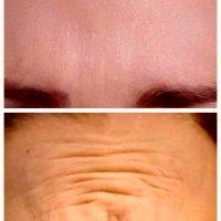 Dr. Dana Goldberg, West Palm Beach Plastic Surgeon Botulinum Toxin Injections