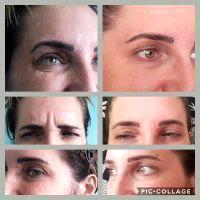 Dr. David C. Mabrie, San Francisco Plastic Surgeon Botox Type A Photo Results