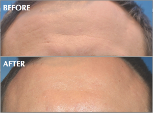 Dr. Henry G. Wells Jr, MD, Plastic Surgeon In Lexington, Kentucky - Forehead Botox