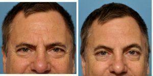 Dr. Kian Karimi, MD, FACS, Los Angeles Facial Plastic Surgeon - Eliminating The 'angry' Look -- Botox To Look Refreshed And Relaxed.