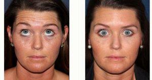 Dr. Sabrina Fabi, MD, San Diego Dermatologic Surgeon - 31 Year Old Woman Treated With Botox