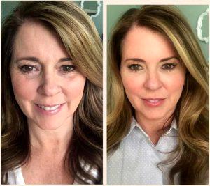 Dysport, Juvederm And Voluma At L.A. Vinas Plastic Surgery, Med Spa And Skin Care Centers