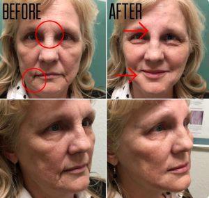 Dysport Restylane And Restylane Silk At Estetica Institute Of The Palm Beaches