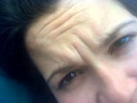 Erasing Your Horizontal Forehead Lines And Crow's Feet