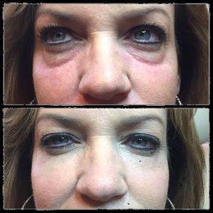 Filler By Dr. Tamir Mosharrafa,PHOENIX, SCOTTSDALE