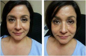 Filler In The Under Eye Area By Michele Hunter RN,Scottsdale, AZ