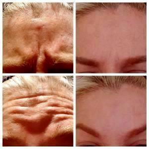 Forehead And Glabella Using Dysport By Dr. Lee E. Corbett, MD, Plastic Surgeon In Louisville, Kentucky