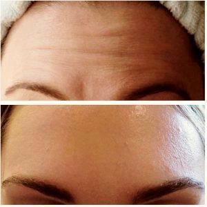 Forehead Botox At Supriya Aesthetic Dermatology, Dermatologist In West Palm Beach, Florida
