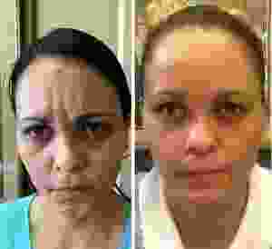 Frown Lines Botox At Estucia Weight Loss And Aesthetics