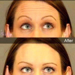 Full BOTOX Cosmetic Treatment Of Forehead For Rejuvenation And Prevention Of Deep Wrinkles.