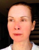 How Can Your Spa Provide Botox Injections