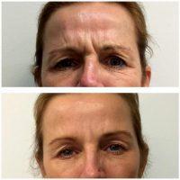 How Much BOTOX You Need Depends On Your Own Muscle Mass