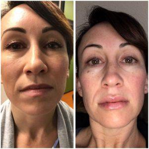 Juvaderm At Avalon Laser, Skin Care Clinic In San Diego, California