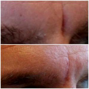 Juvederm By Daniel Yamini, MD, FACS, Doctor In Los Angeles, California