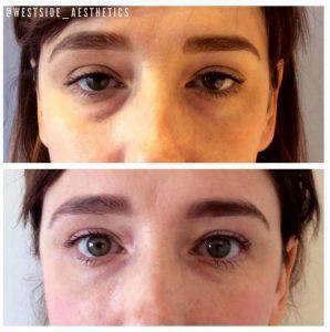 Juvederm By Los Angeles Cosmetic Surgeon Dr. Alexander Rivkin