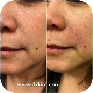 Juvederm Filler By Dr.Kim,San Francisco