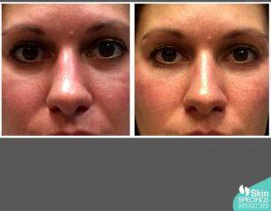 Juvederm Voluma Using Microcannula Technique By Anusha H. Dahanayake, NP, Doctor In Los Angeles, California