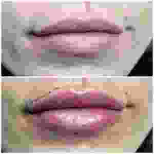 Lip Augmentation In San Diego, SDBotox