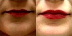 Lip Filler At Waldman Schantz Plastic Surgery Center In Lexington, Kentucky