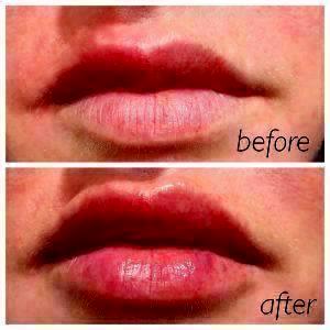 Lip Injections By Dr. Lee E. Corbett, MD, Plastic Surgeon In Louisville, Kentucky