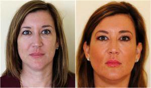 Liquid Face Lift By Dr. Avron Lipschitz, MD, Palm Beach Gardens, FL Plastic Surgeon