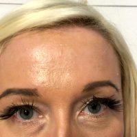 Minimally Invasive Cosmetic Procedures