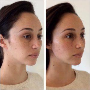 Non Surgical Jaw Enhancement Voluma By Los Angeles Cosmetic Surgeon Dr. Alexander Rivkin