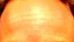 OnabotulinumtoxinA By Dr Kristine Romine, Phoenix Plastic Surgeon