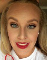 OnabotulinumtoxinA Result By Doctor Melanie D. Palm, San Diego Plastic Surgeon