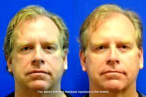 Radiesse Injections To The Cheeks By Dr. Mehta