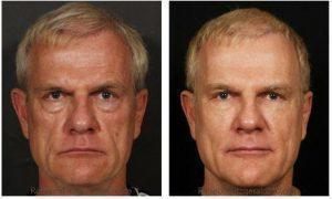 Radiesse, Restylane, Dysport By Dr. Rebecca Fitzgerald, Cosmetic Dermatologist In Los Angeles, Beverly Hills, Larchmont