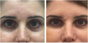 Restylane Dermal Filler To Under Eye Area One Week Post Treatment By Anusha H. Dahanayake, NP, Doctor In Los Angeles, California