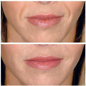 Restylane Lyft Injections To Erase Smile Lines By Los Angeles Cosmetic Surgeon Dr. Alexander Rivkin