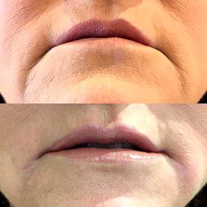 She Was Injected By Aesthetic Nurse Molly At Laser Clinique Using One Syringe Of Belotero