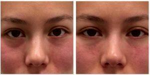 Subtle Under Eye Filler By Anusha H. Dahanayake, NP, Doctor In Los Angeles, California