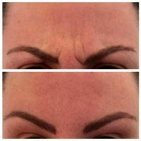 The Botox Images Results With Dr Victor Chung, San Diego Plastic Surgeon