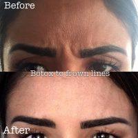 The Botox With Doctor Reza Tirgari, San Diego Plastic Surgeon