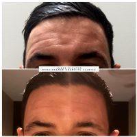 The Duration Of Botox Cosmetic And Dysport Can Vary